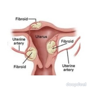  Myomectomy in Navi Mumbai |  Myomectomy  treatment Specialists | Thanawala Vashi